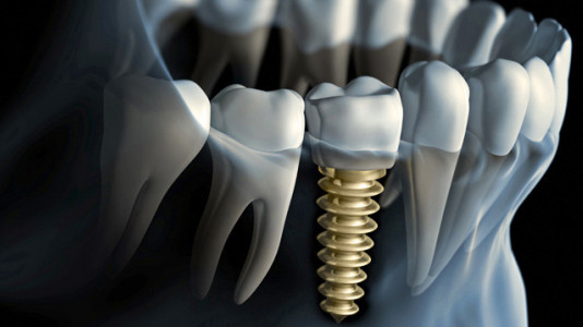Implantáty Implantáty